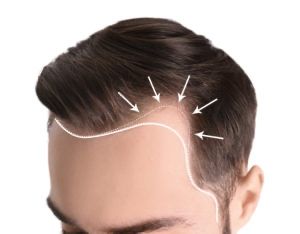 Zone greffe de cheveux