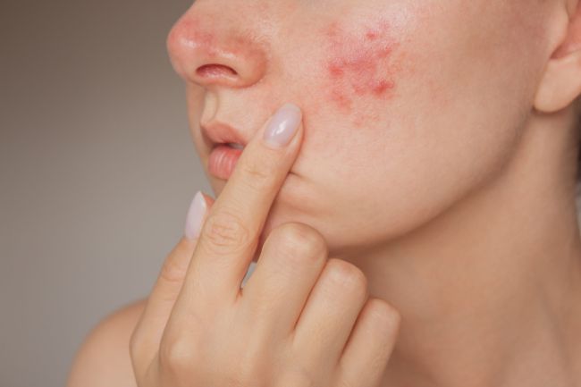 Rougeurs diffuses et rosacée