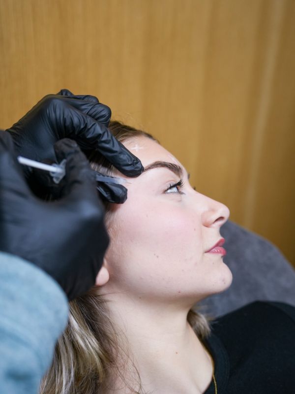 microneedling