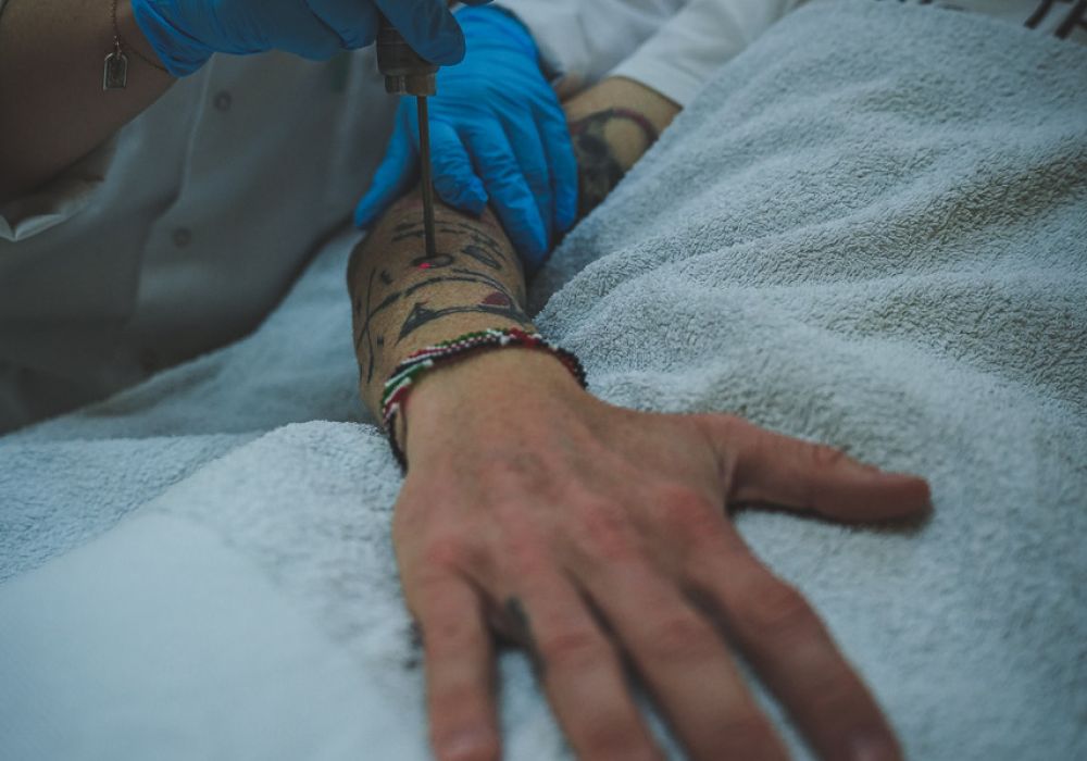 Séance de détatouage