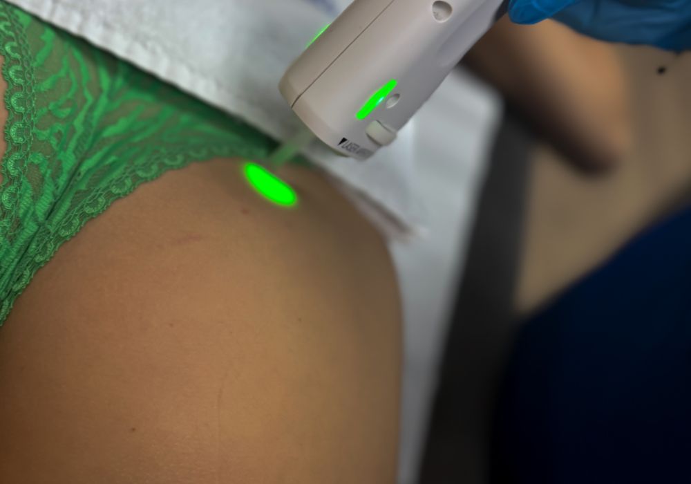 Épilation laser – Fesses (séance)