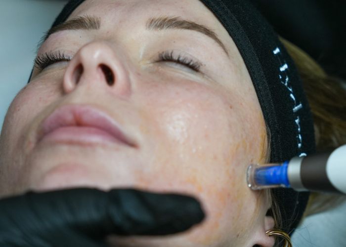 Microneedling