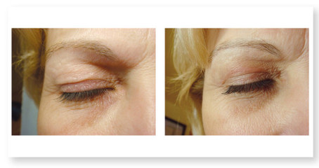 R&eacute;sultat apr&egrave;s traitement 