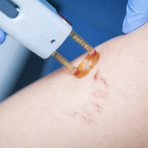 Traitement vasculaire