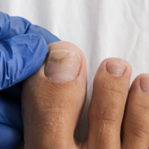 Traitement verrue / onychomycose