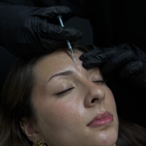 Microneedling (séance)