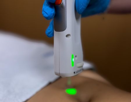 Épilation laser – Ligne ombilicale (séance)