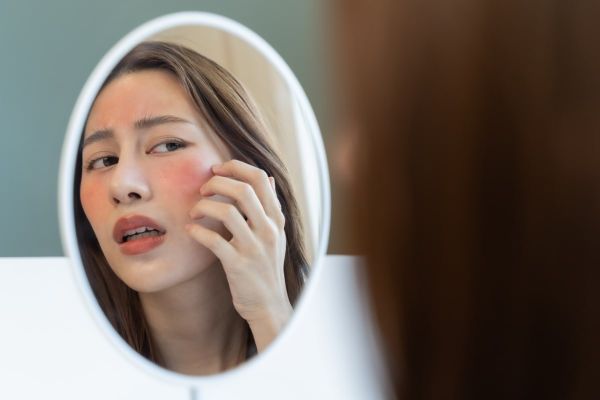 Lésions vasculaire sur les joues