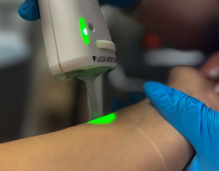 Épilation laser – Avant-bras (séance)