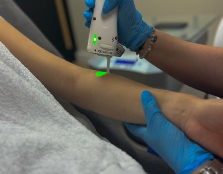 Épilation laser – Bras complets (séance)