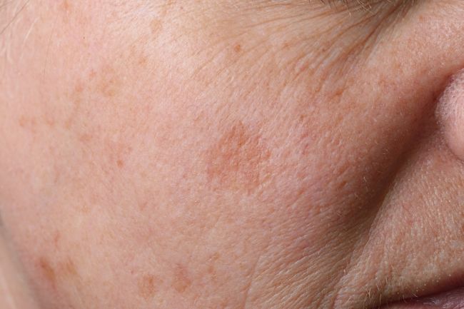 Hyperpigmentation : tâches brunes, mélasma
