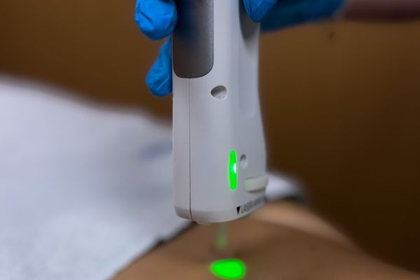 Épilation laser – Abdomen (séance)