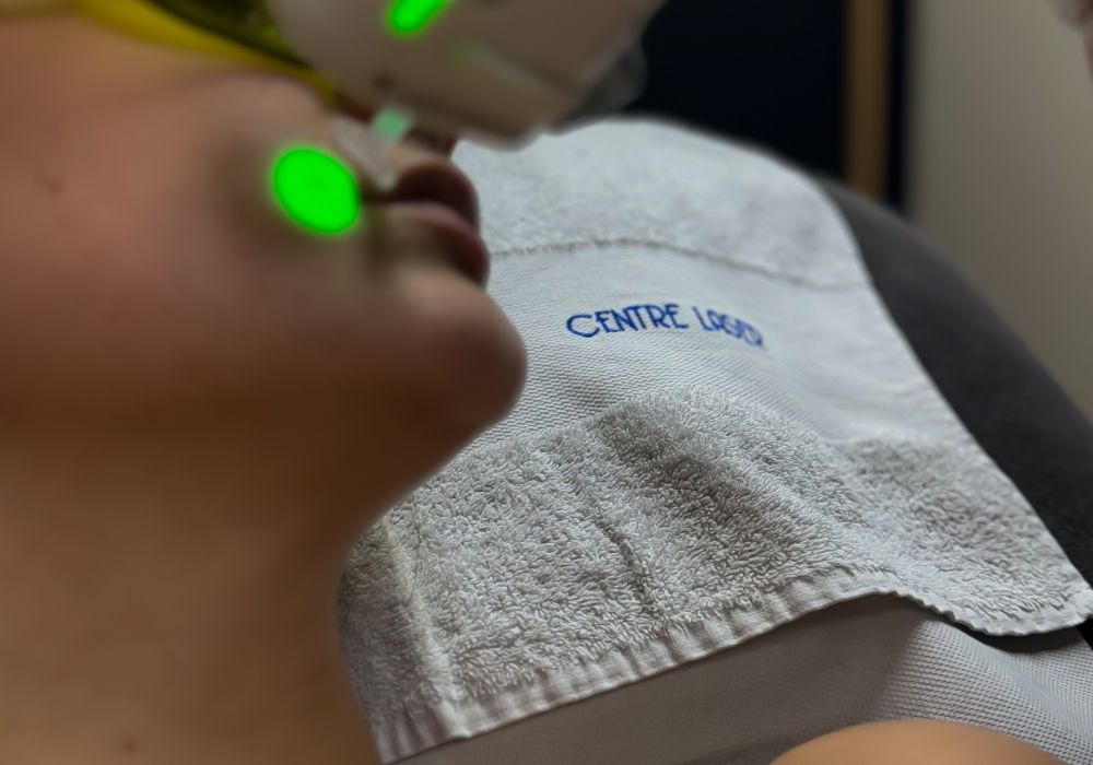 Épilation laser – Lèvre supérieure (séance)