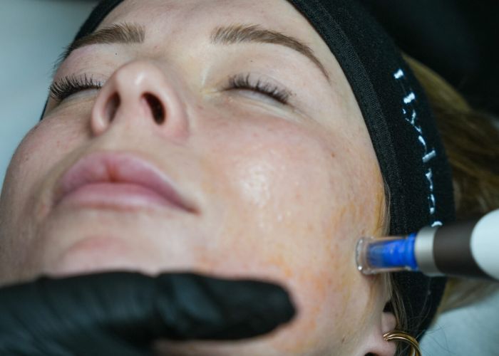 Microneedling