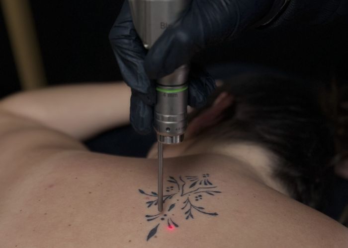 détatouage