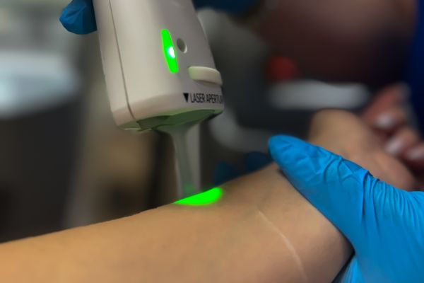 Épilation laser – Avant-bras (séance)