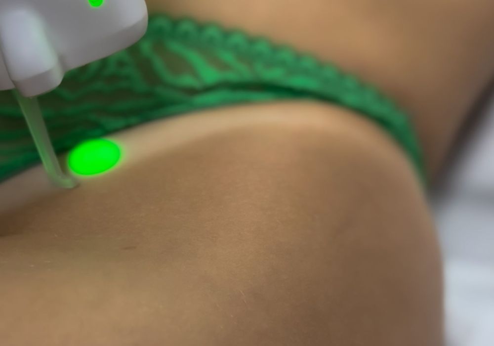 Épilation laser – Aisselles + Maillot intégral (séance)