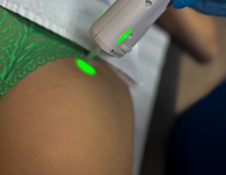 Épilation laser – Fesses (séance)
