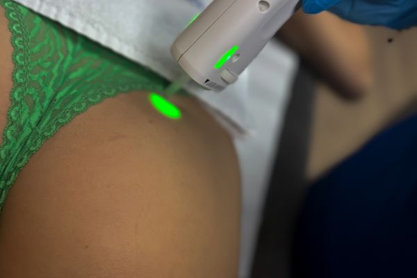 Épilation laser – Fesses (séance)