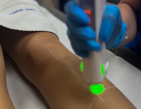 Épilation laser – Demi-jambes (séance)