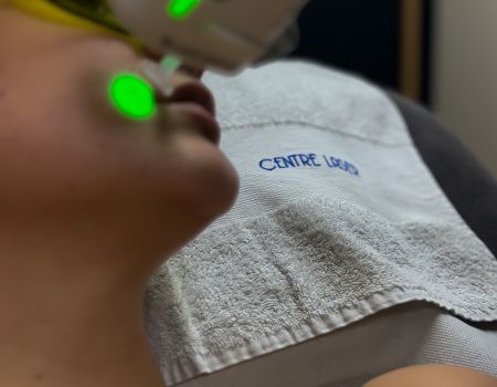 Épilation laser – Lèvre supérieure (séance)