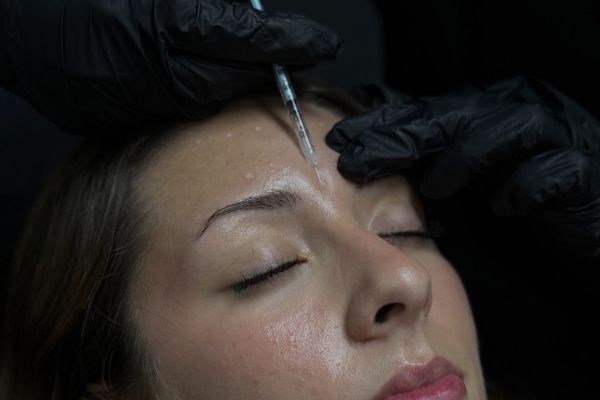 Microneedling – Séance
