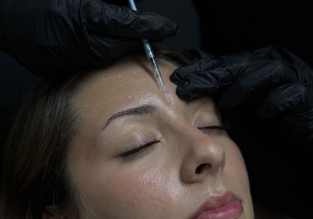 Microneedling (s&eacute;ance)