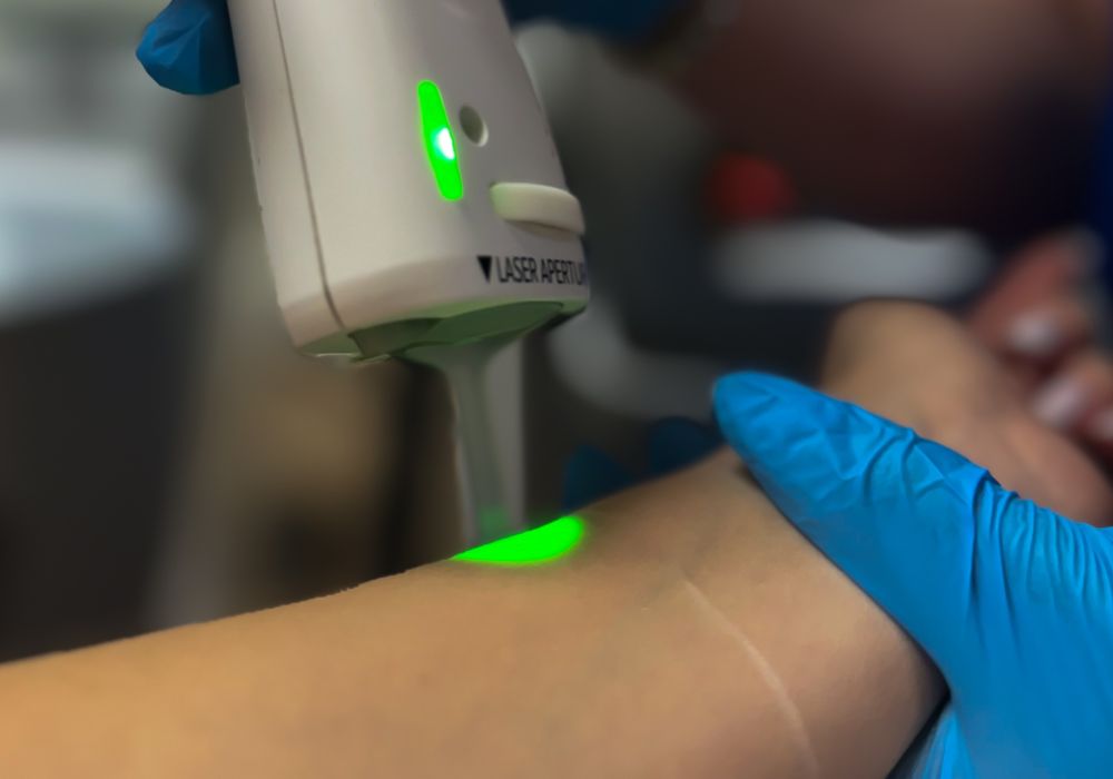 Épilation laser – Avant-bras (séance)