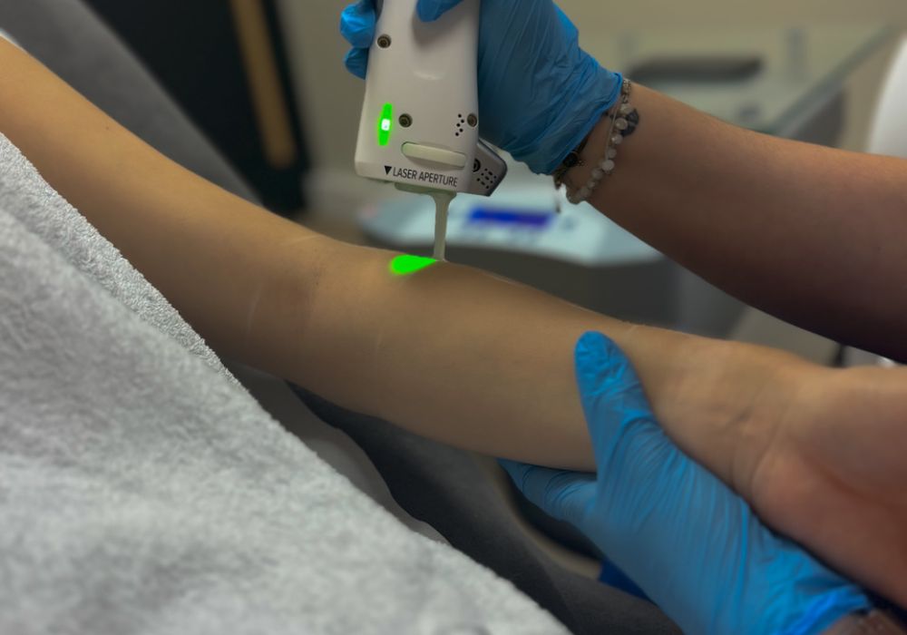 Épilation laser – Bras complets (séance)